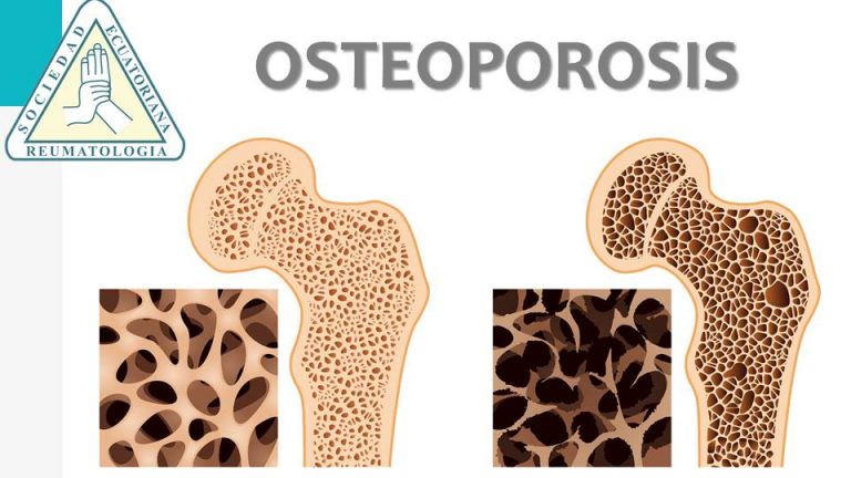 OSTEOPOROSIS Sociedad Ecuatoriana de Reumatología