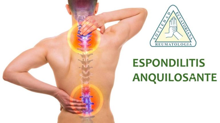 Espondilitis Anquilosante Qu Es S Ntomas Diagn Stico Y Tratamiento